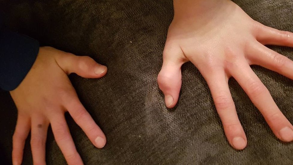 Большие пальцы рук мальчиков опухшие