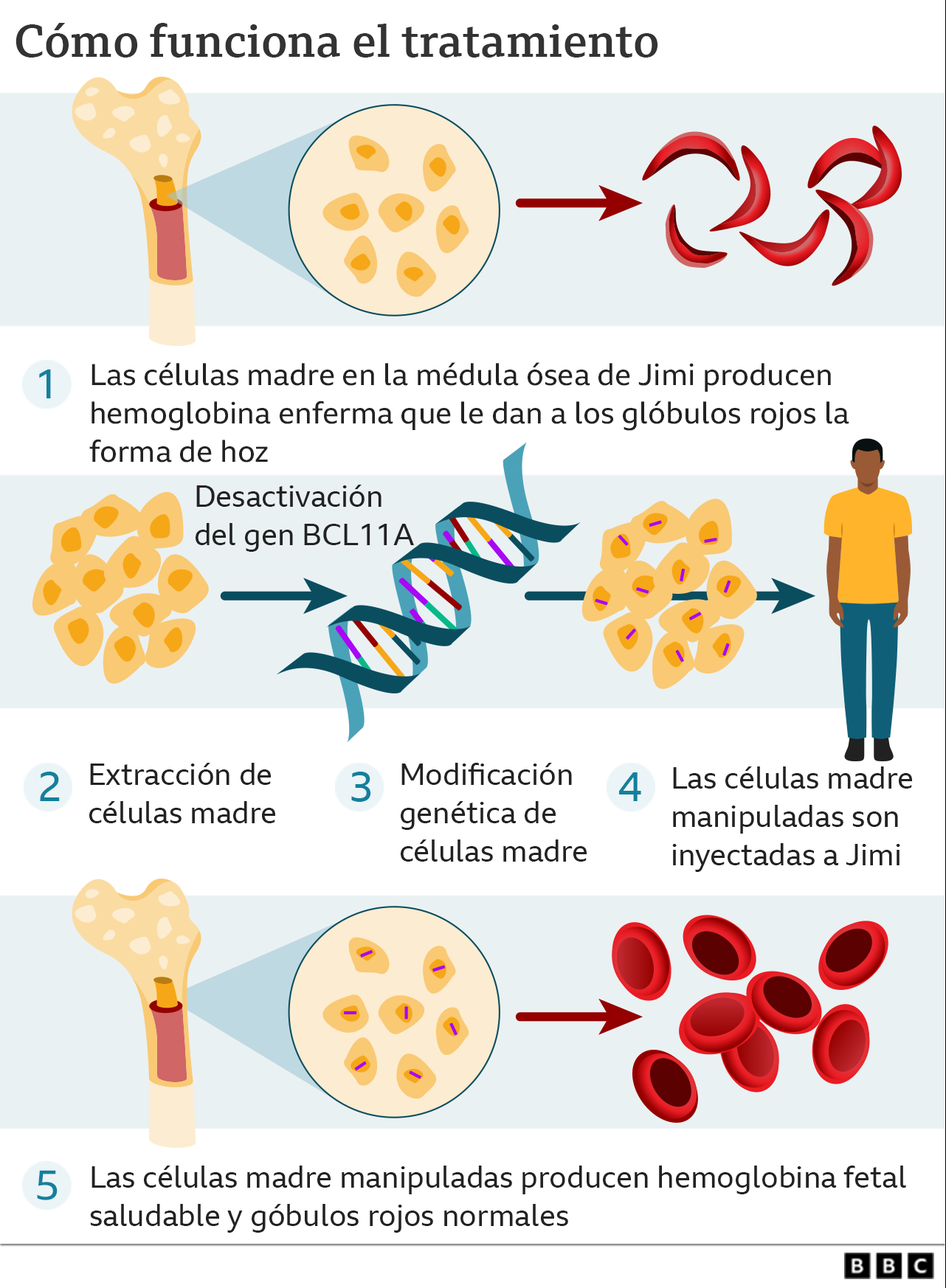 Gráfico que ilustra la terapia para tratar la anemia de células falciformes
