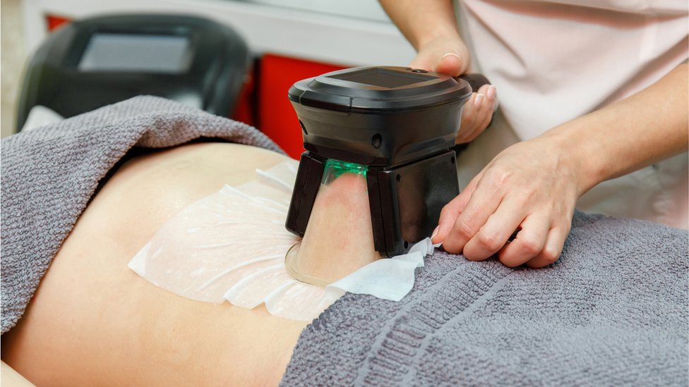 Unwanted fat is frozen in a clamp during cryolipolysis