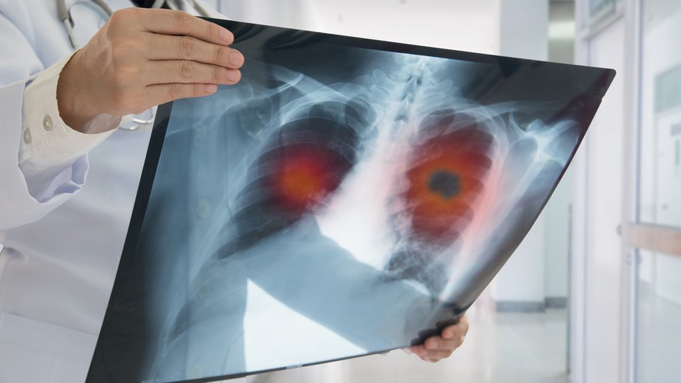 Un médico con una radiografía de pulmones.