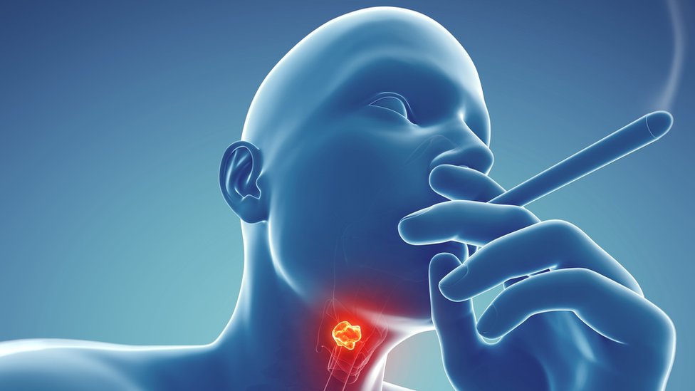 What Does Cancer In Throat Look Like Oral Cancer Screening Brook 