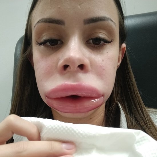 Pamela Andrade com inchaço labial