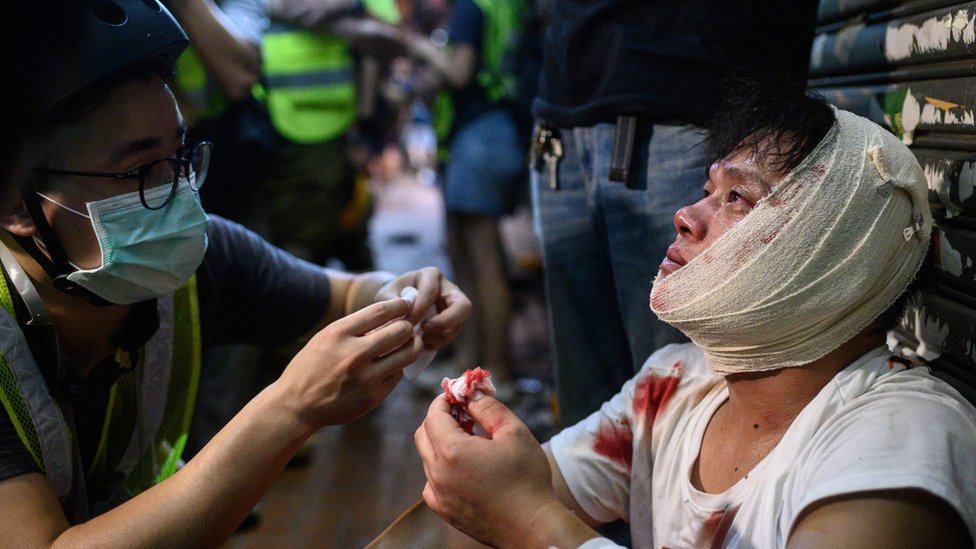 Manifestante en Hong Kong herido.