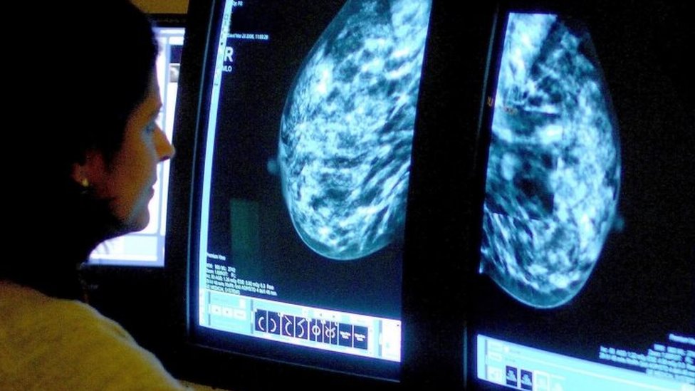 mamogram görüntüleri