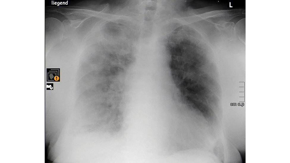 Raio X mostra pulmões esfumaçadoes