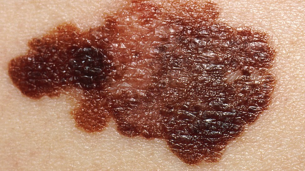 Pinta típica de um melanoma