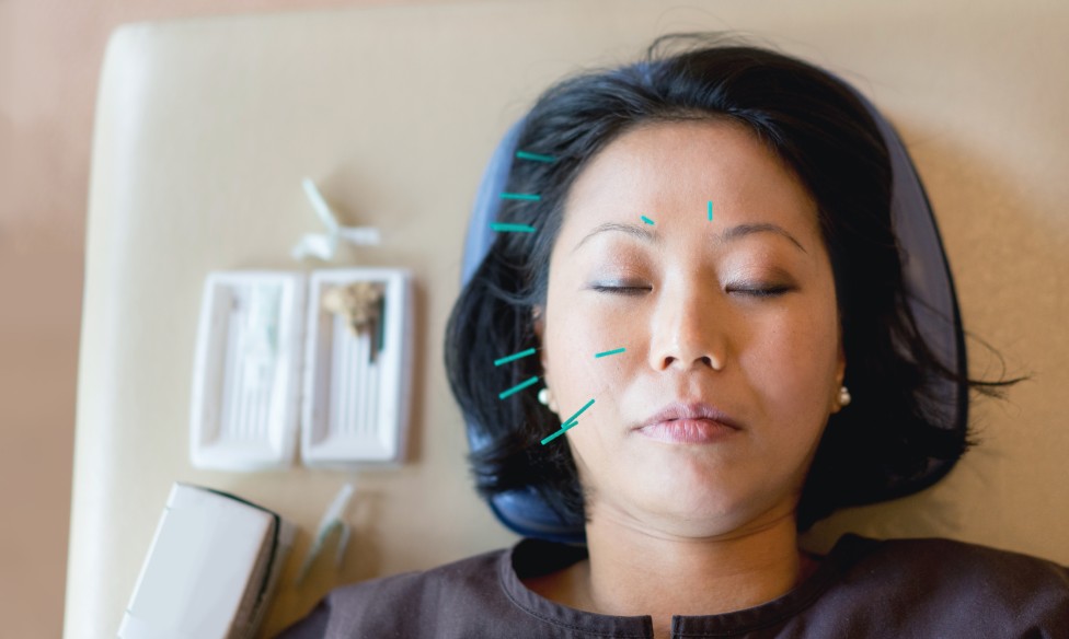 Mujer con agujas en una sesión de acupuntura