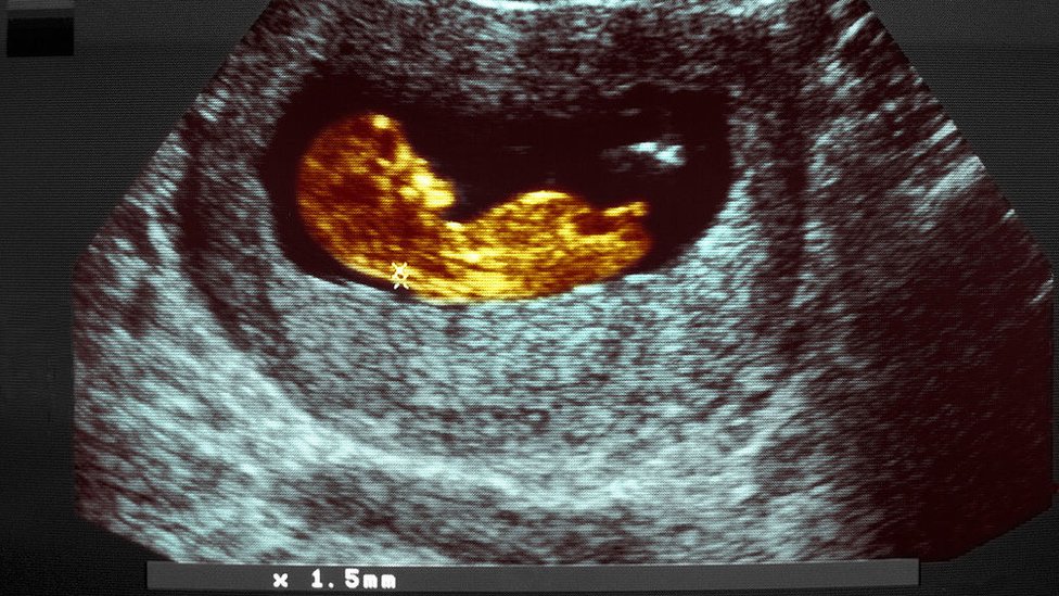 Imagen de ultrasonido de un feto en el vientre