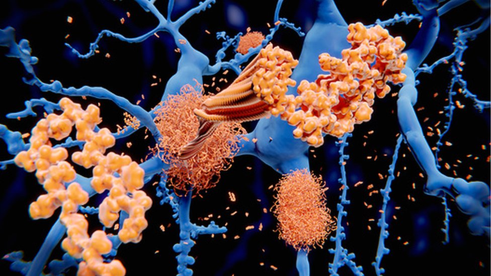 設計圖片：澱粉樣蛋白斑塊在腦內積聚