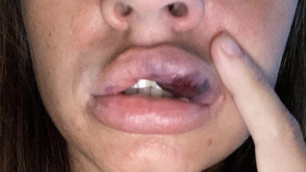 South Shields woman feared 'losing lips' after botched filler - BBC News