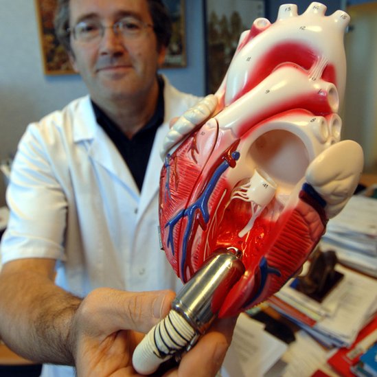 Un médico muestra el Jarvik 2000, el primer dispositivo de asistencia ventricular alimentado por batería.