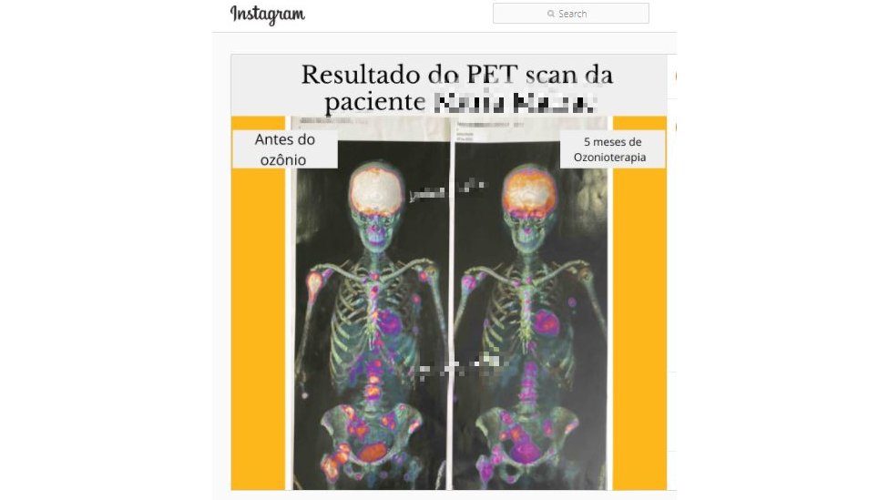 Postagem no Instagram mostra duas imagens de tomografia, a mais recente com menos manchas no corpo