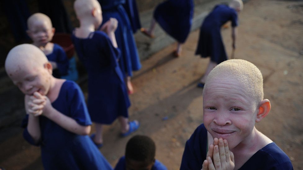 albinos