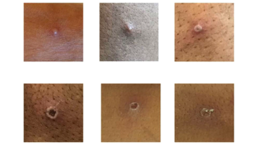 Seis imagens de peles com pequenas feridas de varíola