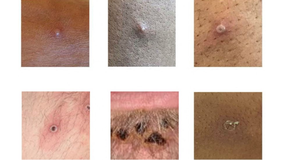 Some examples of lesions suggestive of monkeypox