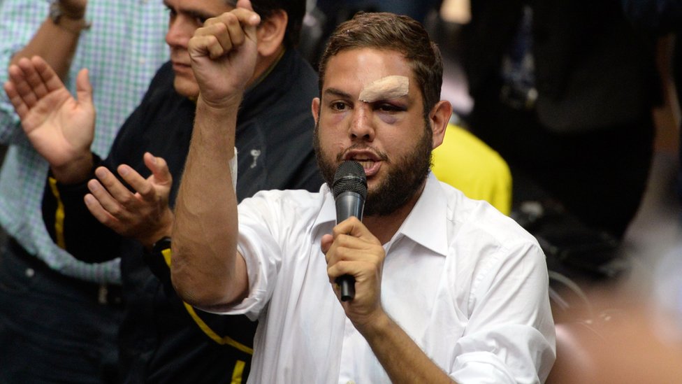 Juan Requesens es uno de los jóvenes diputados que está en primera fila en las protestas, por lo que ha sufrido lesiones. Juan Requesens