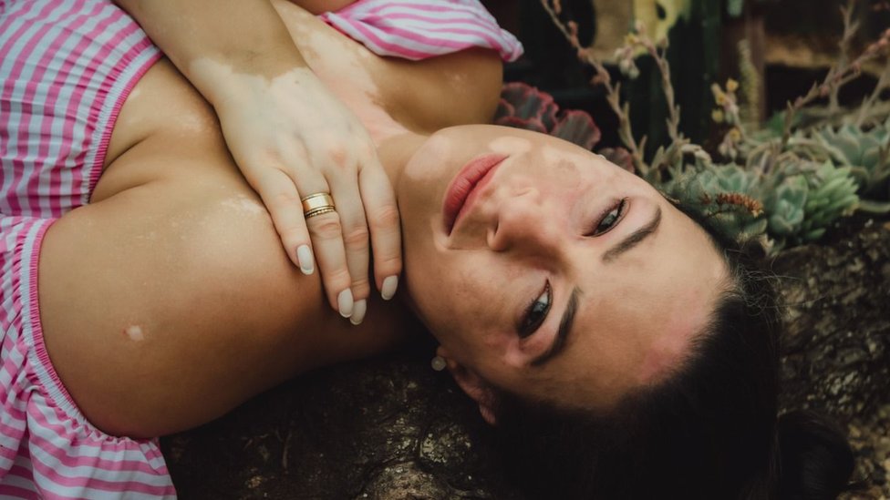 Maika Celi deitada em foto em que mostra as manchas de vitiligo