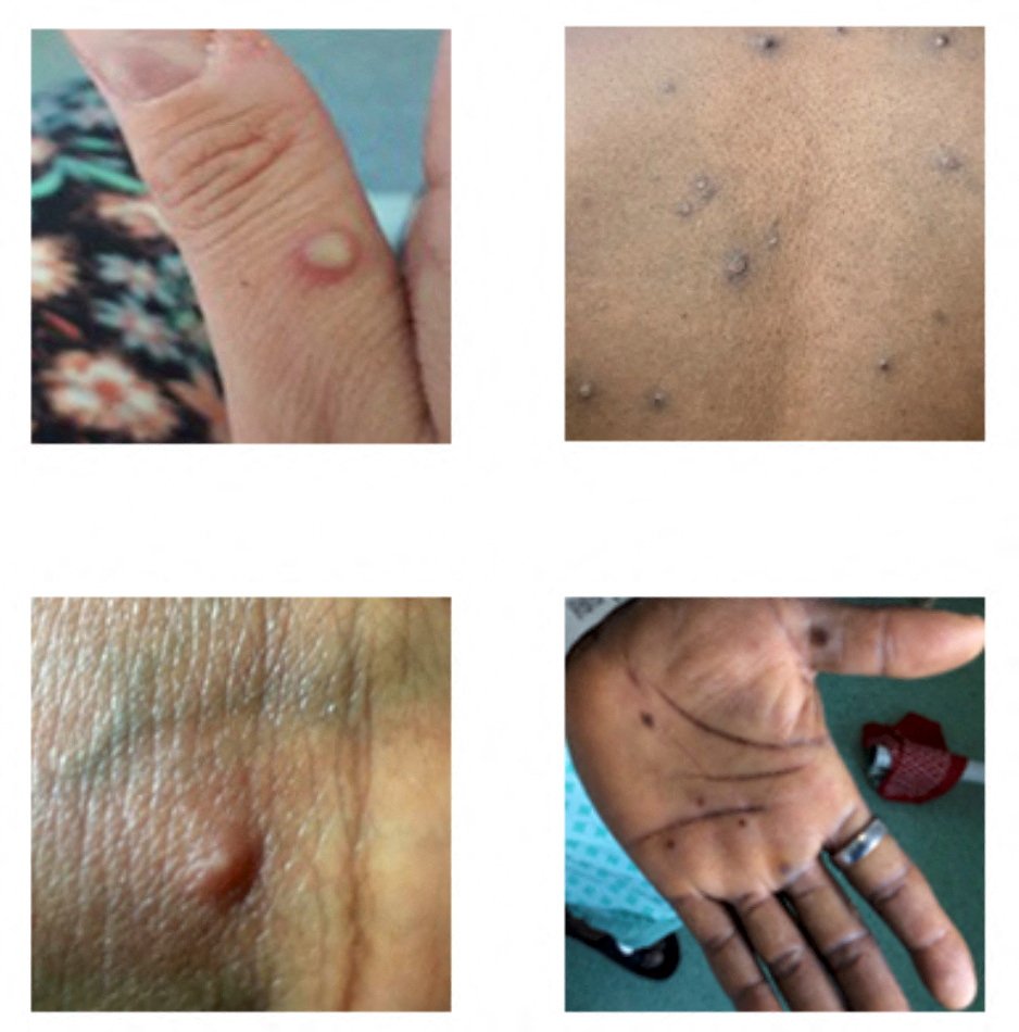 Characteristic lesions of monkeypox