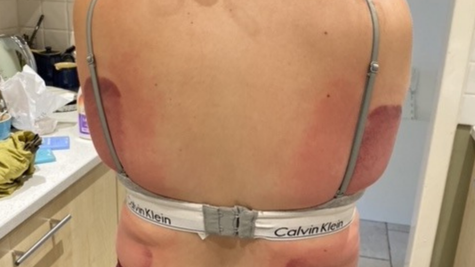A photo of a woman's back with bruising