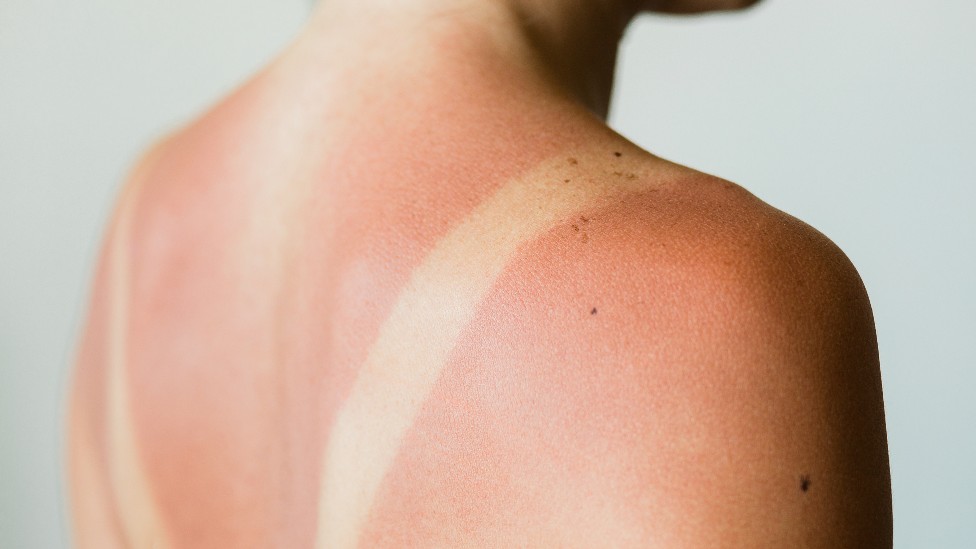 Espalda de una mujer con marcas de quemaduras solares