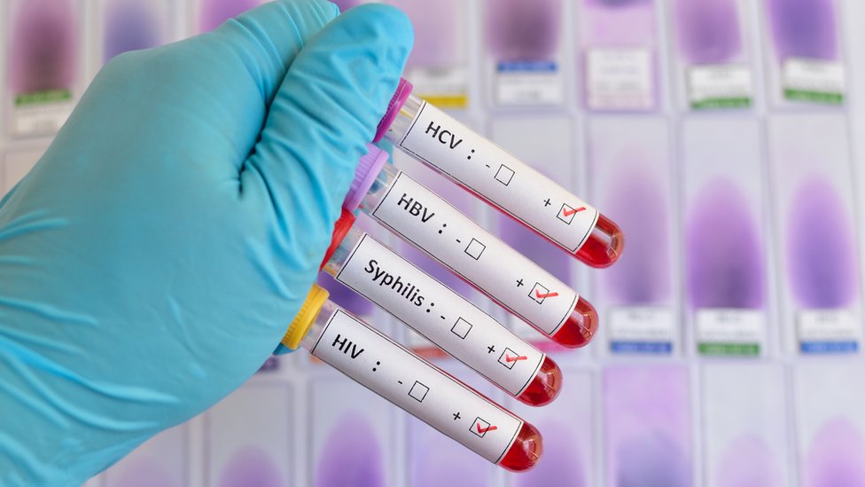 Фотография человека в резиновых перчатках, держащего четыре пробирки с образцами крови. На контейнерах есть этикетки с надписью «ВГС, ВГВ, сифилис и ВИЧ»