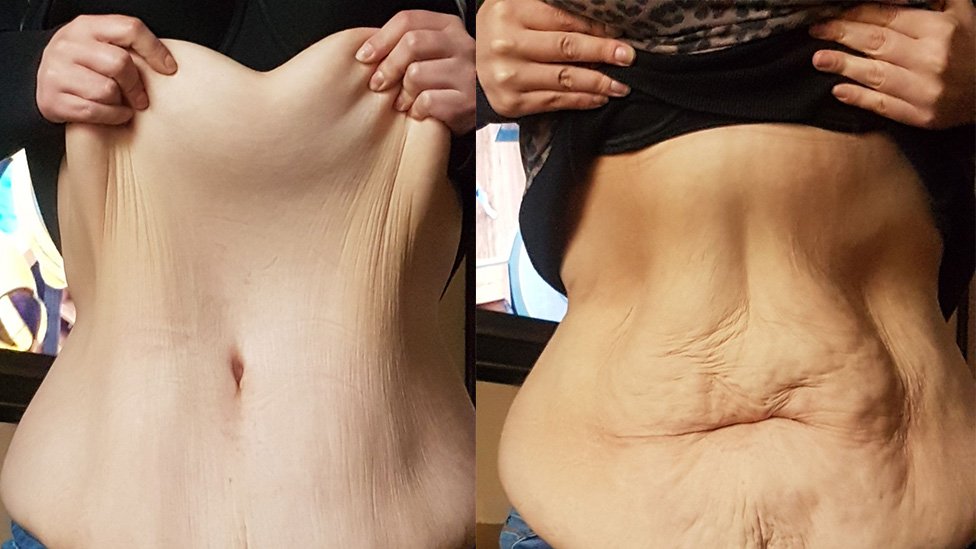 After Huge Weight Loss, Sagging Skin Remains