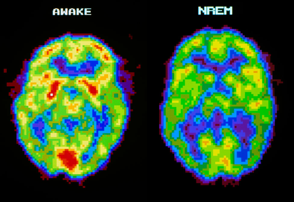 Escáner de cerebro con la persona dormida y despierta.