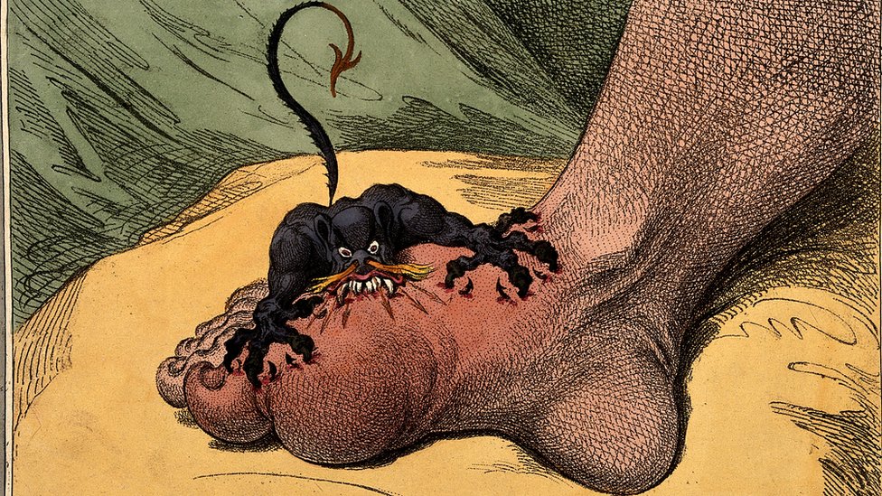 El dolor nos ha atormentado siempre y ha sido representado de una variedad de formas, como ésta, en la que el artista J. Gillray, expresó lo que se siente al sufrir de gota con un demonio atacando un pie (1799).