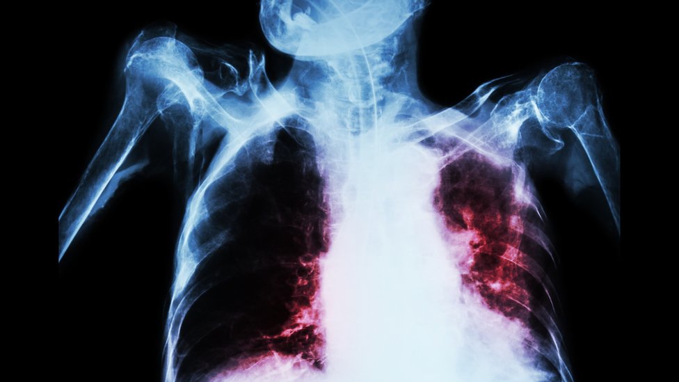 Рентген туберкулеза легких - модель Thinkstock