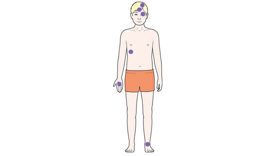 Mapa de partes del cuerpo que pueden desarrollar