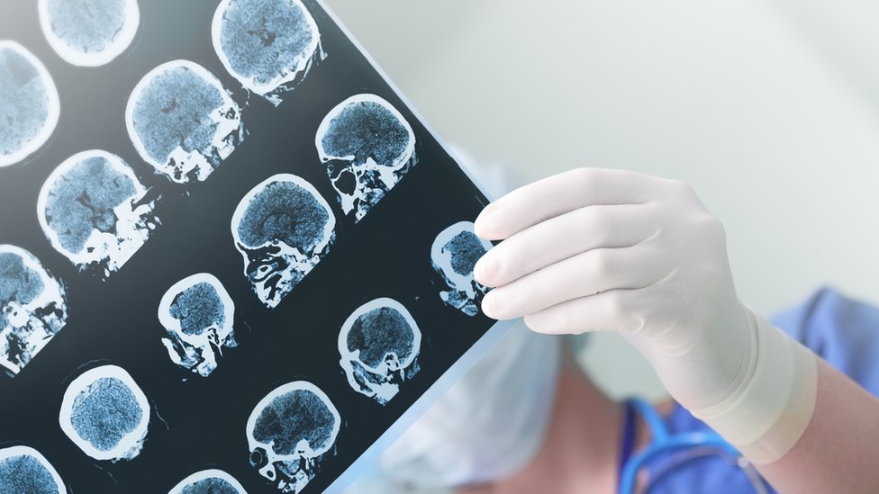 Imágenes de rayos X de un cerebro.