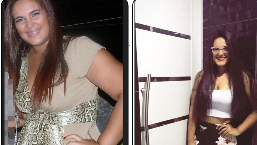 Raquel antes y después de la cirugía.