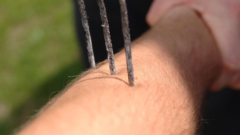Las emociones negativas afectan nuestra empatía hacia quienes sienten dolor. Foto: Alamy Un dispositivo de metal pinchando el brazo de una persona Foto Alamy