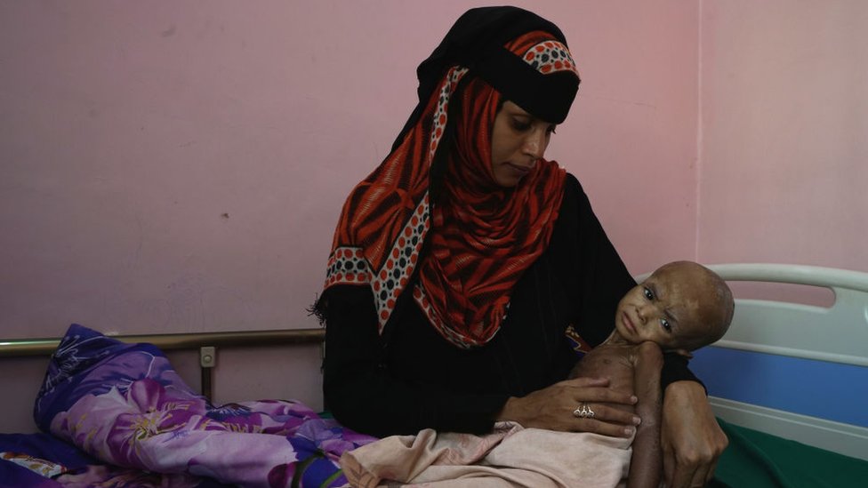 На фото мать в клинике недалеко от Худайды с недоедающим ребенком.