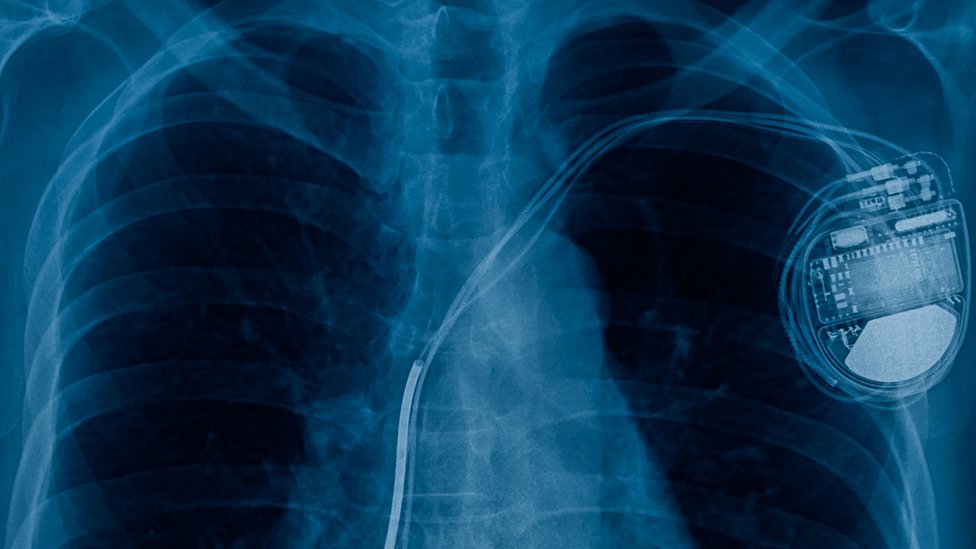 Рентген кардиостимулятора