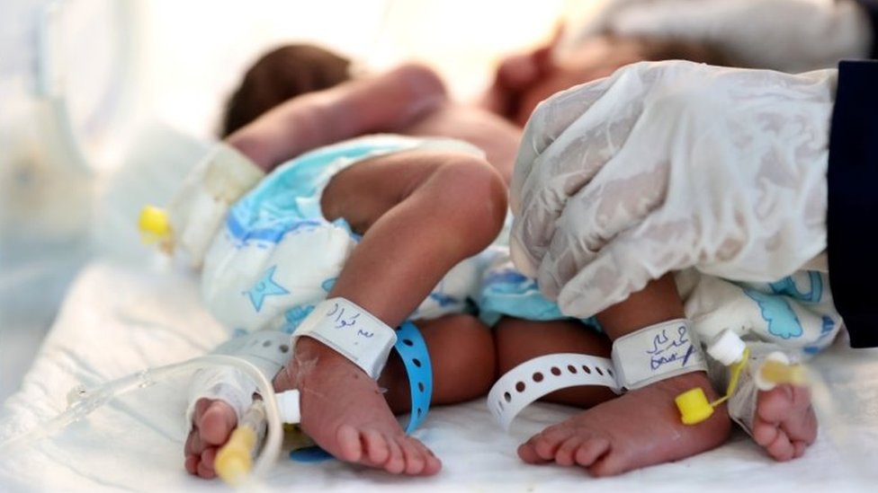 A nurse attends to newly born conjoined twins in an incubator at the child intensive care unit of al-Sabeen hospital in Sanaa, Yemen. Photo: 18 December 2020