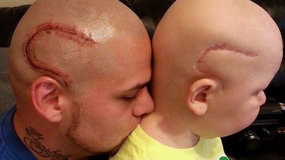 Kansas dad gets a tattoo to match his son's brain cancer surgery scar - BBC News