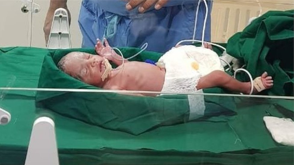 Radha dilahirkan prematur pada bulan Oktober dengan berat 1,45 kg