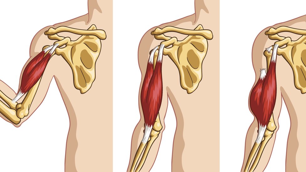 Aquí se observa la ruptura de un tendón en el extremo proximal, más común en la gente joven. Gráfico de la ruptura de un tendón.