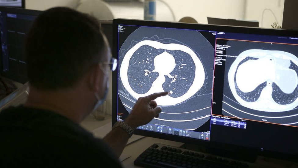Un cirujano señala un tumor canceroso en una tomografía de pulmón