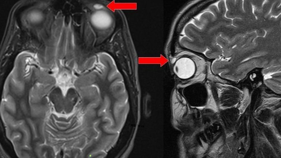Una resonancia magnética mostró el quiste sobre el ojo de la mujer.