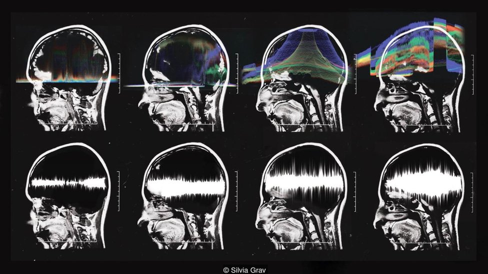 Algunas partes del cerebro relacionadas con la música se mantienen intactas en los pacientes con Alzheimer. Foto: Silvia Grav. Serie de escaneos cerebrales. Foto: Silvia Grav.