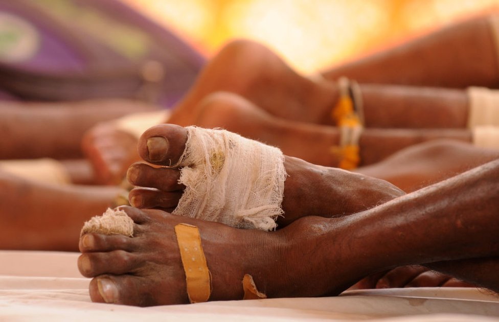 Ушибленные ступни кавариев, перевязанных бинтами, во время отдыха во время путешествия 7 августа 2018 года в Гуруграме, Индия.