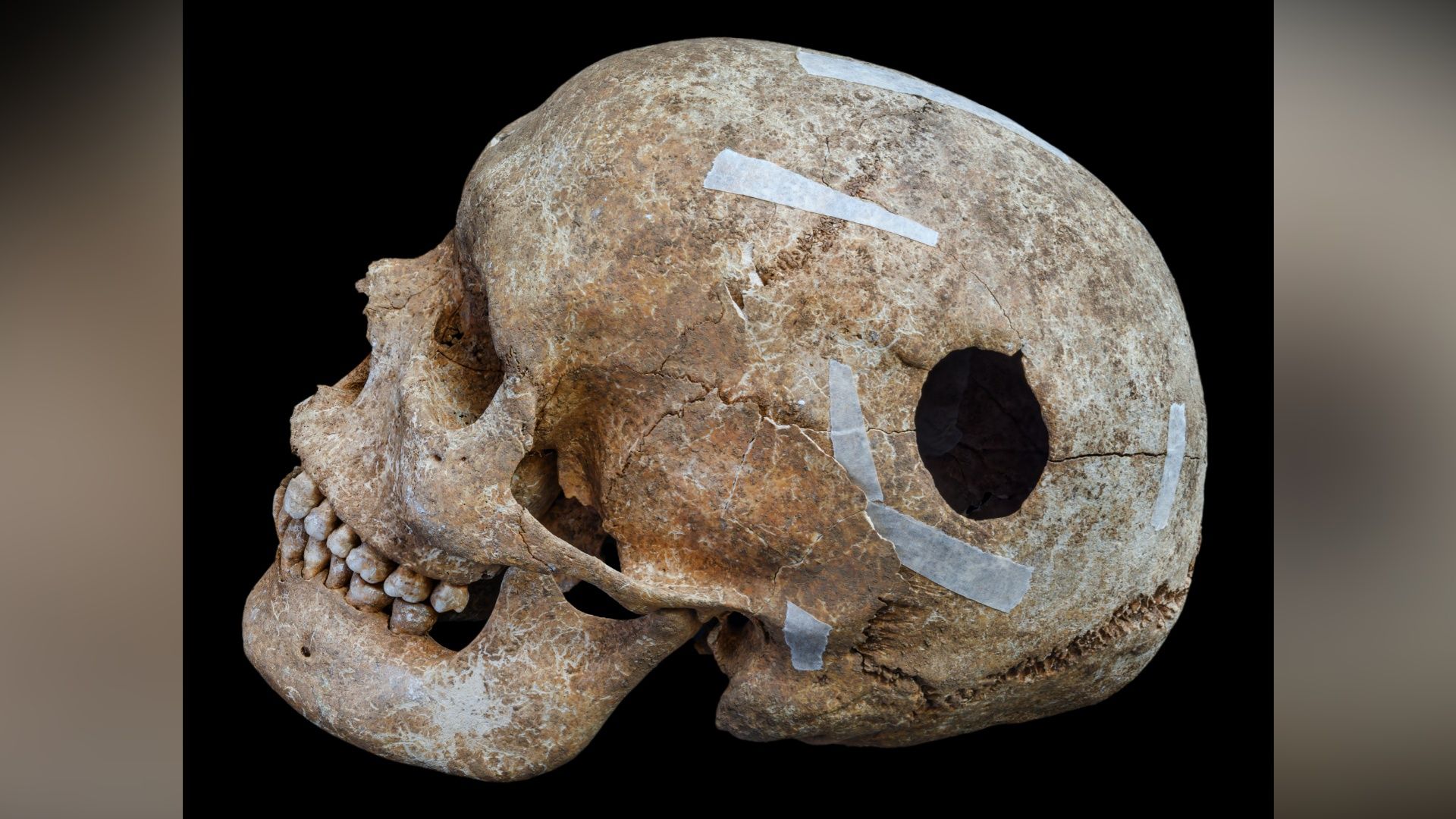 洋楽 Num skull/when suffering comes Wandlebury's Viking-era mass grave finds include trepanned skull