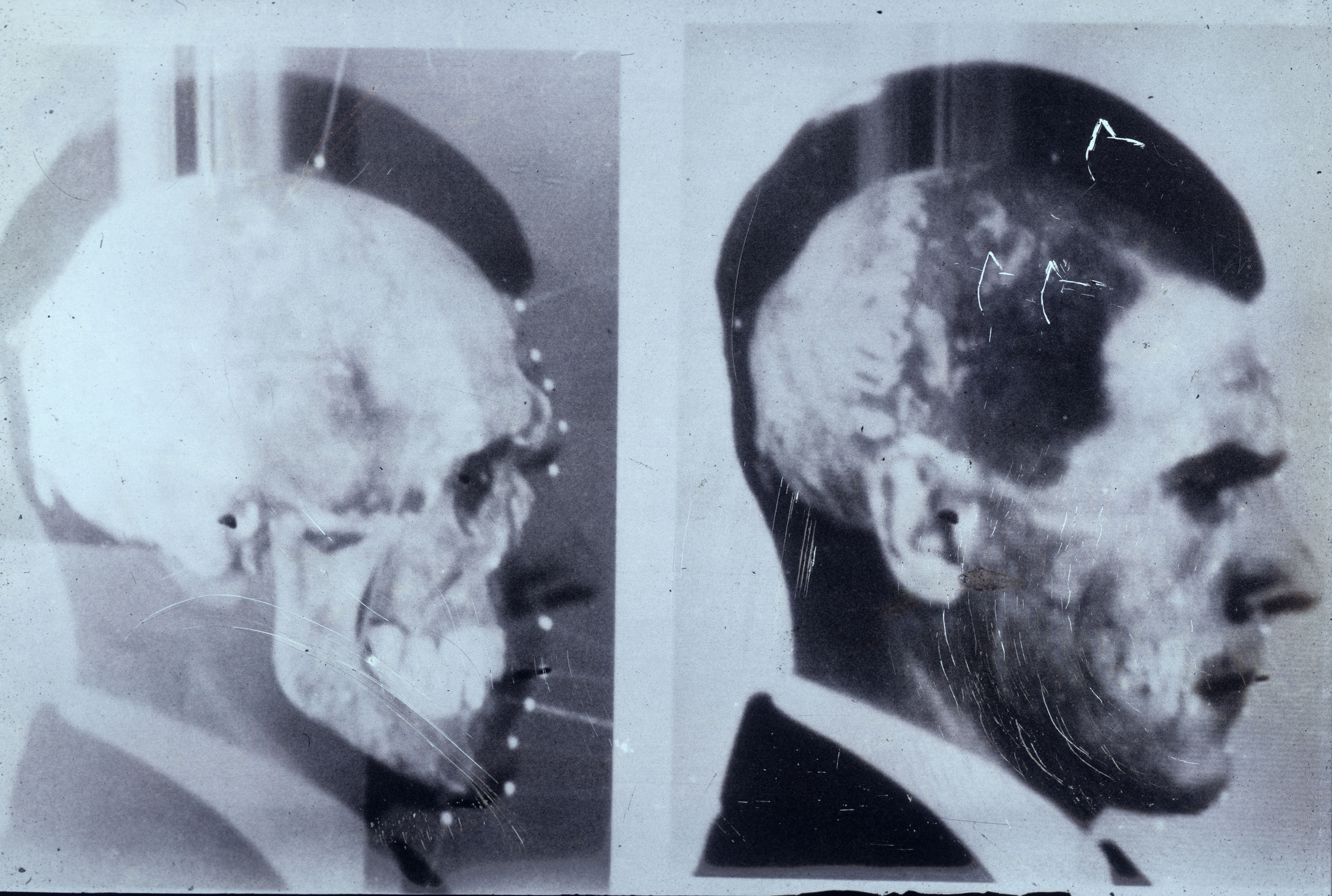 Imágenes de Josef Mengele con el cráneo superpuesto.
