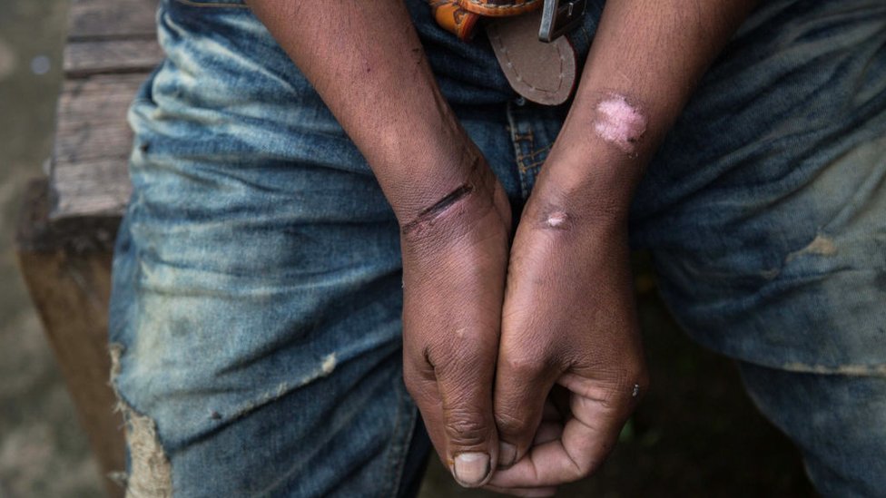 Un trabajador indocumentado en Tailandia muestra las heridas que le causaron las esposas cuando fue arrestado. Las autoridades de ese país han implementado nuevas regulaciones para combatir la trata de personas. Un hombre con heridas
