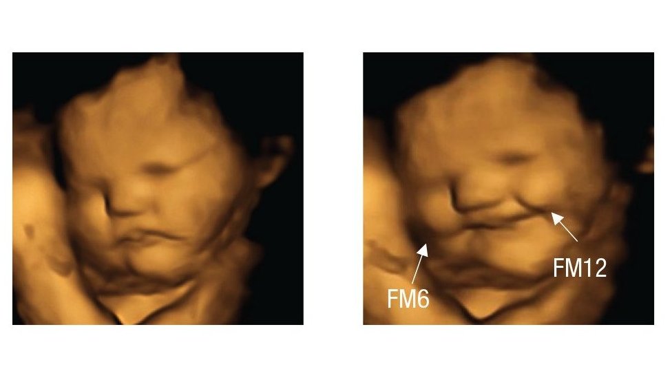 Imagen 4D de lo que parece ser un feto sonriendo.