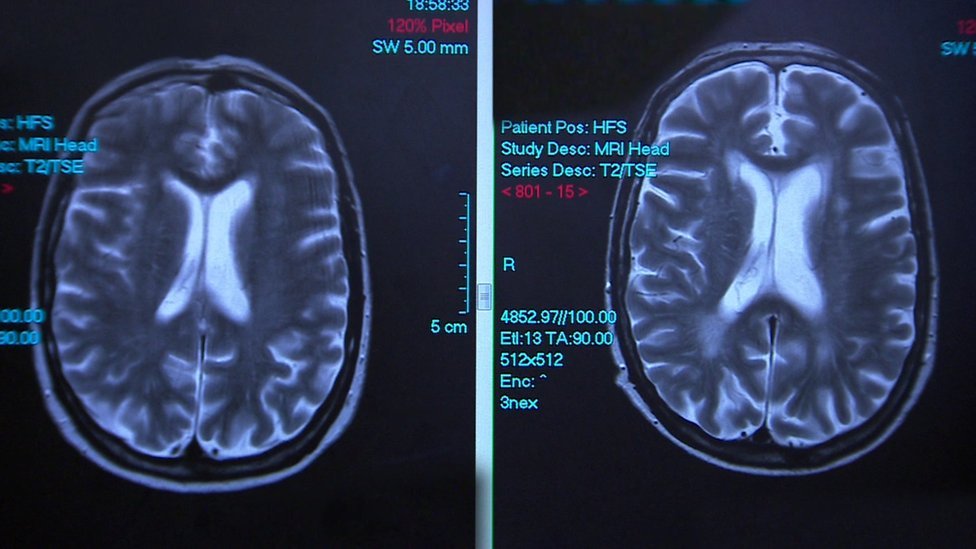 Brain scans of the same person, eight years apart, the enlarged white areas on later scan on the right are alcohol damage