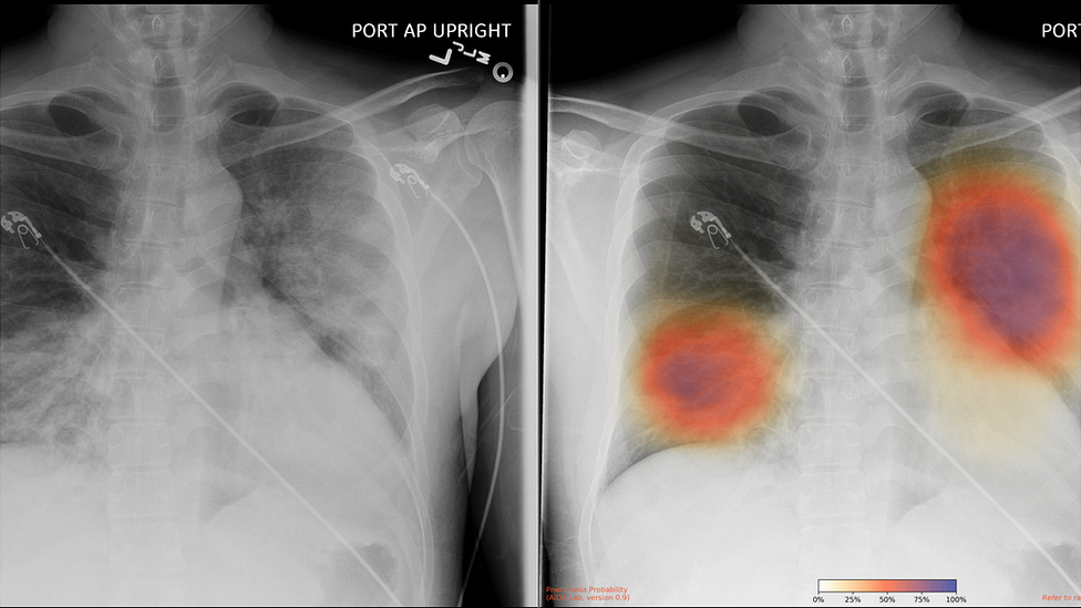 The Groundbreaking Way To Search Lungs For Signs Of Covid 19 c News