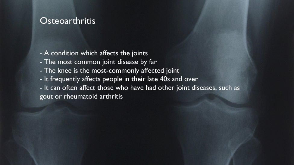 Рентген двух колен с некоторыми фактами об остеоартрозе